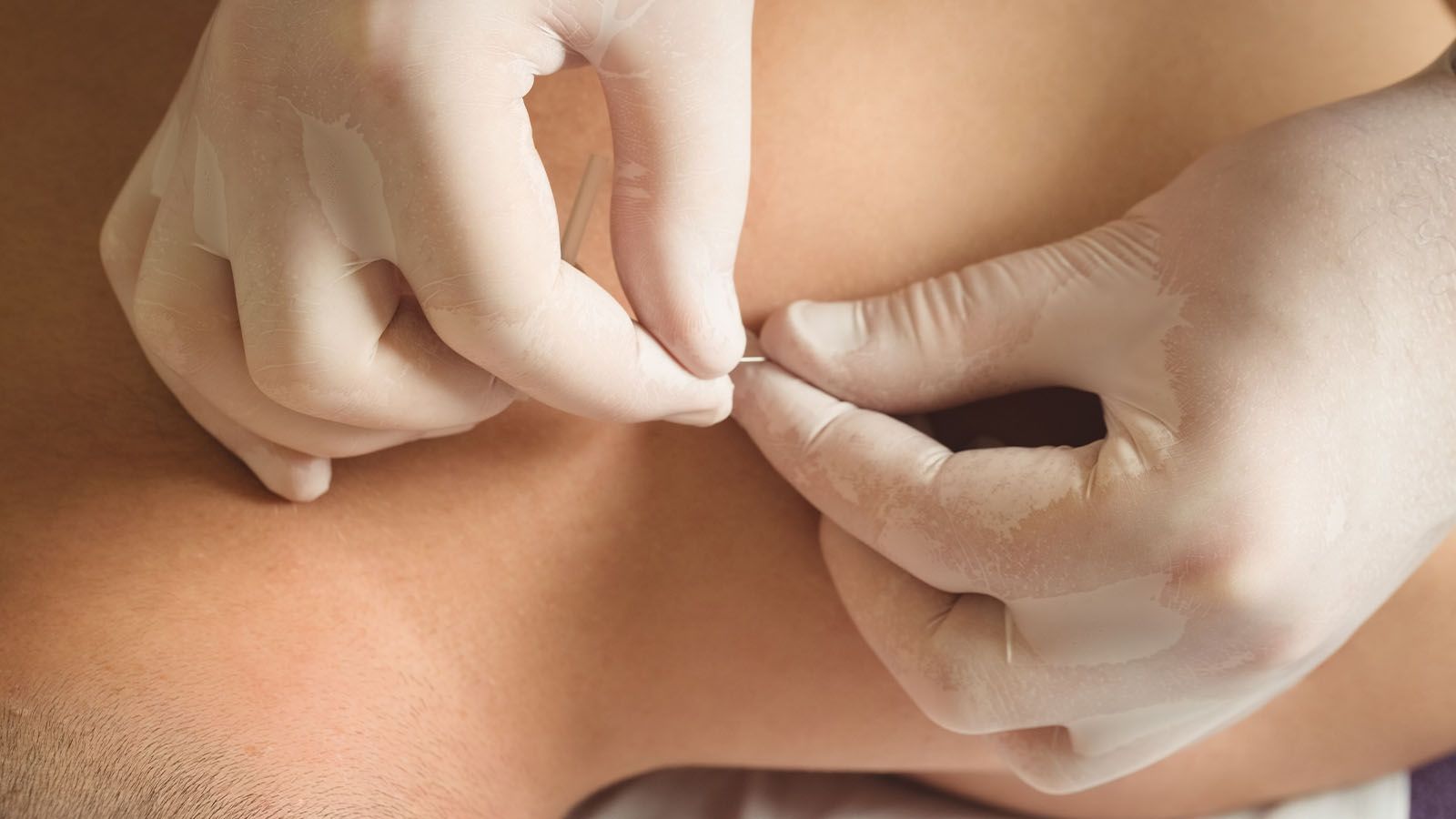 Dryneedling voor mannen bij Bodyland