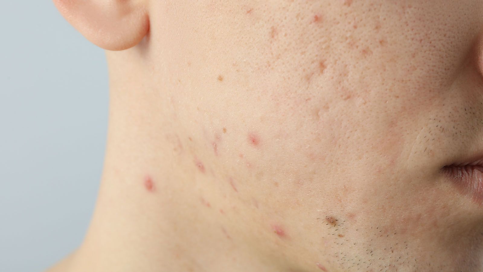 Acne Care gezichtsbehandeling voor mannen bij Bodyland